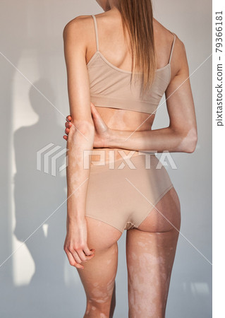 Gorgeous naked woman showing nude back with vitiligo affected skin 79366181