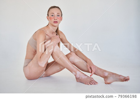 Woman with vitiligo disease sitting in front if the white wall and looking at the camera 79366198