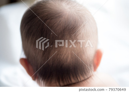 頭上有藥丸的嬰兒 頭上有藥丸的嬰兒 79370649