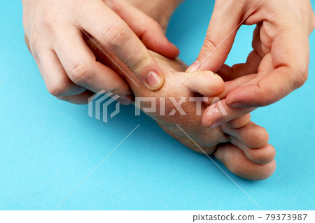 Fungus of foot close-up, isolated on blue background. The concept dermatology, treatment fungal and fungal infections in humans. Macro photograph human parasites. Rear background of a dermatologist 79373987