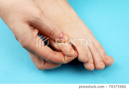 Fungus of foot close-up, isolated on blue background. The concept dermatology, treatment fungal and fungal infections in humans. Macro photograph human parasites. Rear background of a dermatologist Fungus of foot close-up, isolated on blue background. The concept dermatology, treatment fungal and fungal infections in humans. Macro photograph human parasites. Rear background of a dermatologist 79373988