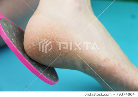 Cleaning foot feet with a saw or brush. Cleaning the feet of the fungus Cleaning foot feet with a saw or brush. Cleaning the feet of the fungus 79374004