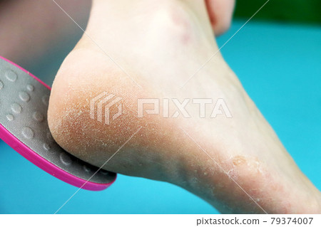 Cleaning foot feet with a saw or brush. Cleaning the feet of the fungus 79374007