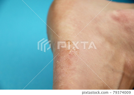 Fungus of foot close-up, isolated on blue background. The concept dermatology, treatment fungal and fungal infections in humans. Macro photograph human parasites. Rear background of a dermatologist Fungus of foot close-up, isolated on blue background. The concept dermatology, treatment fungal and fungal infections in humans. Macro photograph human parasites. Rear background of a dermatologist 79374009