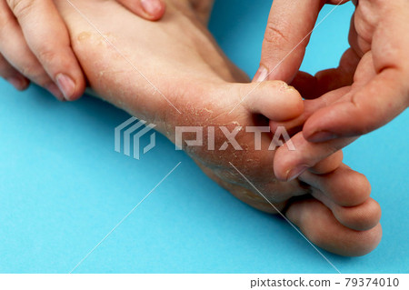 Fungus of foot close-up, isolated on blue background. The concept dermatology, treatment fungal and fungal infections in humans. Macro photograph human parasites. Rear background of a dermatologist 79374010