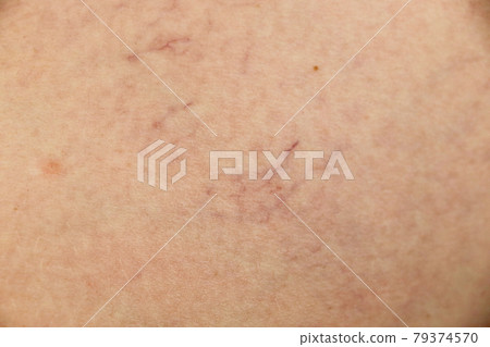 Varicose veins and capillary veins in the legs. Medical inspection and treatment Varicose veins and capillary veins in the legs. Medical inspection and treatment 79374570