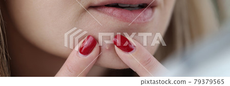 Young woman squeezing out pimple with her hands closeup 79379565
