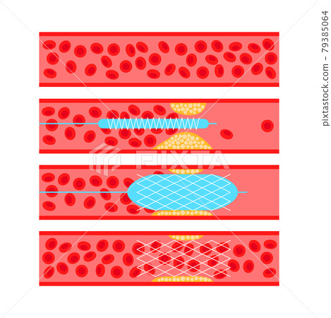 Angioplasty cardiac stent 79385064