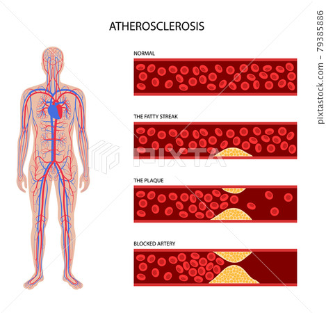 Cholesterol and atherosclerosis 79385886