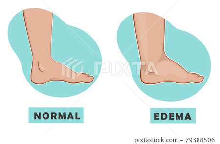 A swollen foot and ankle and a normal foot. Vector illustration A swollen foot and ankle and a normal foot. Vector illustration 79388506