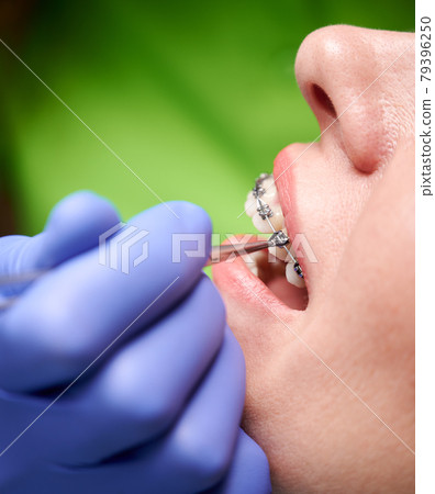 Orthodontist hands placing braces on woman teeth. 79396250