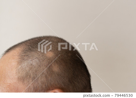 Circular hair loss Circular hair loss 79446530
