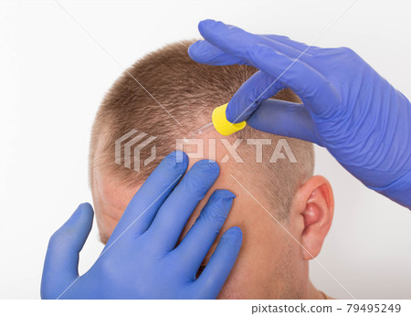 Healing oil for scalp hair restoration. Hair follicle restoration, close-up. Dihydrotestosterone 79495249