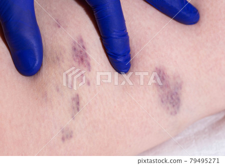 Bruises and thrombosis on the legs of a woman. Phlebeurysm, close-up, chronic 79495271