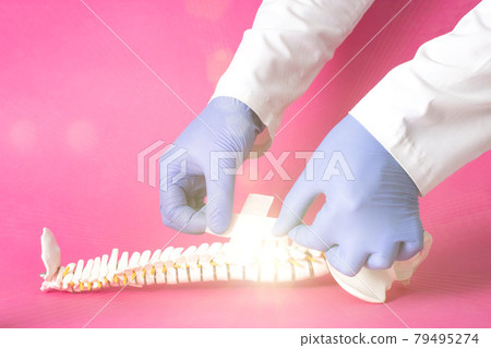 Doctor glues a medical plaster on the mock up of the human spine, pink background. Spinal fracture treatment concept, microdiscectomy and vertebroplasty. Copy space for text Doctor glues a medical plaster on the mock up of the human spine, pink background. Spinal fracture treatment concept, microdiscectomy and vertebroplasty. Copy space for text 79495274