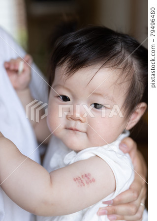 Cute toddler inoculated with BCG 79496480
