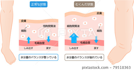 Swelling of the legs, how the water content is balanced, cross-sectional view of the skin, before and after 79518363