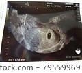 Pregnancy 5w Pregnant woman echo 79559969