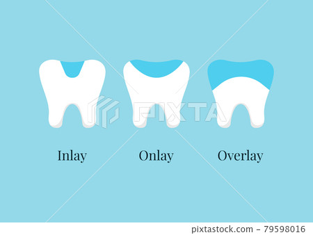 Tooth dental ceramic inlay, onlay, overlay or crown treatment set. Tooth dental ceramic inlay, onlay, overlay or crown treatment set. 79598016