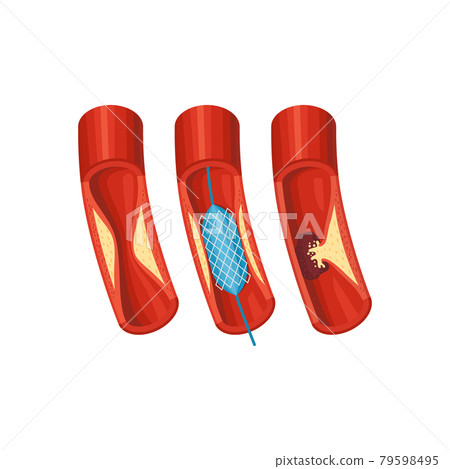 Aorta Diseases Illustration Aorta Diseases Illustration 79598495