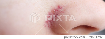 On wings of nose, skin after removal of vascular mesh On wings of nose, skin after removal of vascular mesh 79601797