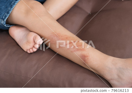 Wounds, scratches and abrasions on skin of child leg. Children injury. Wounds, scratches and abrasions on skin of child leg. Children injury. 79616213