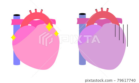 A simple illustration of the heart. Two, healthy and unhealthy. 79617740