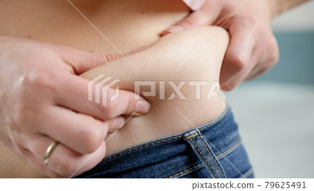 Closeup of fat folds on big belly of overweight woman. Concept of excessive weight, obese female, dieting and overweight problems 79625491