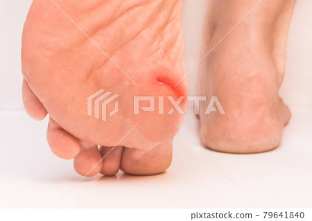 Legs of an elderly woman with a wound on the foot on a white background, close-up Legs of an elderly woman with a wound on the foot on a white background, close-up 79641840