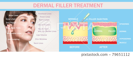 Treatment areas for anti-wrinkle injection. Young female with clean fresh skin. Beautiful woman. Female face and neck. Portrait of young caucasian woman . Treatment areas for anti-wrinkle injection. Young female with clean fresh skin. Beautiful woman. Female face and neck. Portrait of young caucasian woman . 79651112