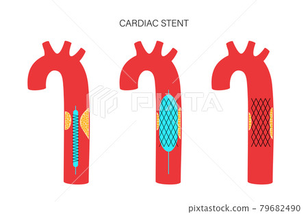 Angioplasty cardiac stent 79682490