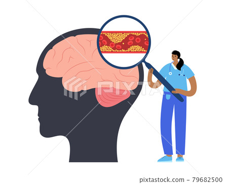 Brain stroke ishemic Brain stroke ishemic 79682500