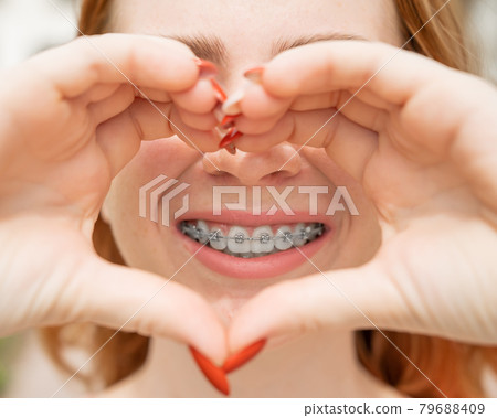 Close-up portrait of a young red-haired woman with braces on her teeth holding her hands in the shape of a heart. Orthodontic appliances for a perfect smile. Close-up portrait of a young red-haired woman with braces on her teeth holding her hands in the shape of a heart. Orthodontic appliances for a perfect smile. 79688409