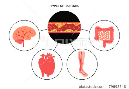 Types of ishemia Types of ishemia 79698548