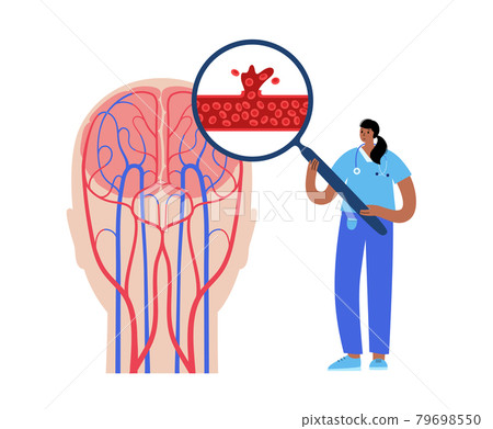 Brain stroke hemorrhagic 79698550