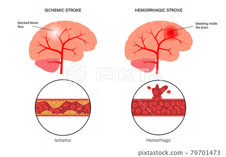 Brain stroke ishemic and hemorrhagic 79701473