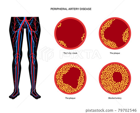 Peripheral artery disease 79702546