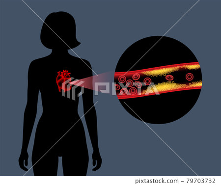 Cholesterol heart disease 79703732