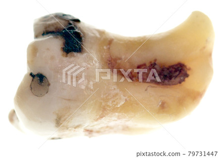 Wisdom tooth Wisdom tooth 79731447