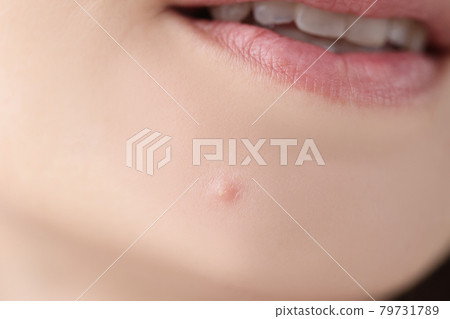 Closeup of white pimple on chin skin of young woman 79731789