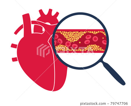 Cholesterol heart disease Cholesterol heart disease 79747706