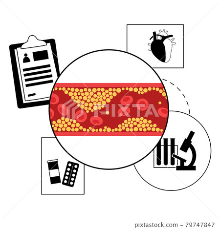 Cholesterol heart disease 79747847