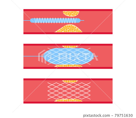 Angioplasty cardiac stent Angioplasty cardiac stent 79751630