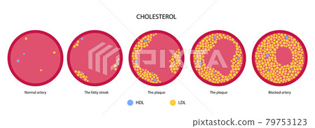 Cholesterol blood artery 79753123