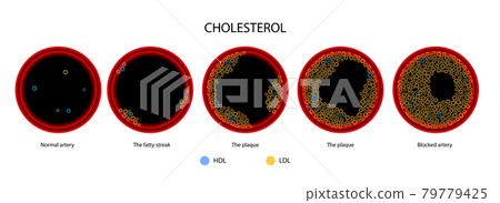 Cholesterol blood artery 79779425