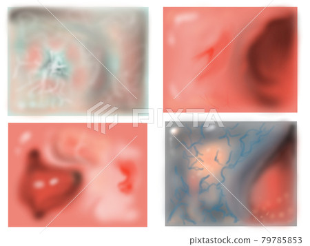 圖 4 早期胃癌黏膜形態 79785853