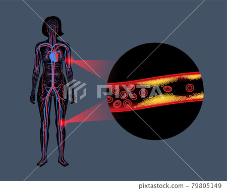 Peripheral artery disease - Stock Illustration [79805149] - PIXTA