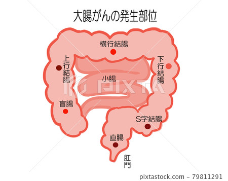 Illustration of the site of colorectal cancer Illustration of the site of colorectal cancer 79811291
