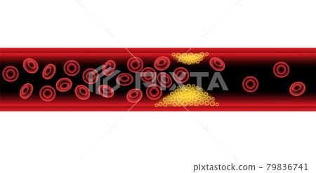 Cholesterol and atherosclerosis Cholesterol and atherosclerosis 79836741