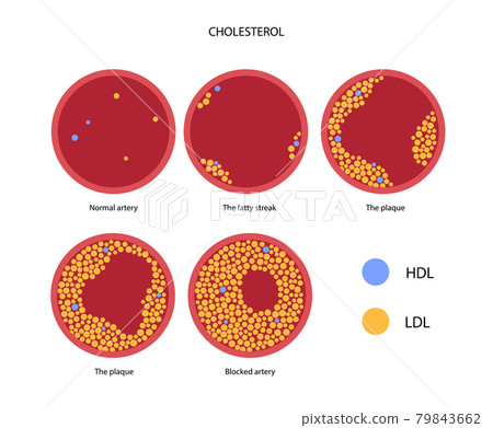 Cholesterol blood artery Cholesterol blood artery 79843662